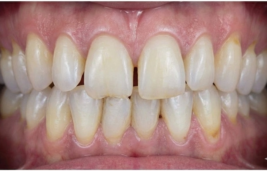 לפני הטיפול