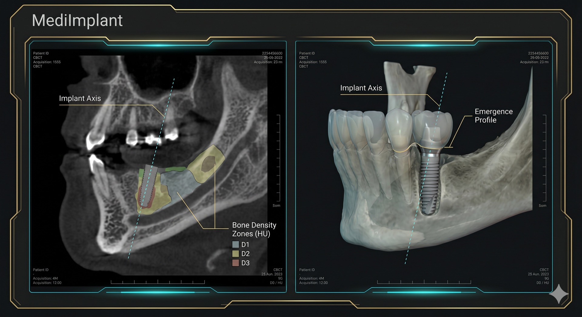 MediImplant
